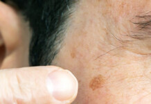 Melanoma or Age Spots? How to Tell the Difference