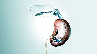 diabetes insipidus MOBILE