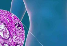 New Report Reveals Australia’s Fastest-Growing Women’s Cancer
