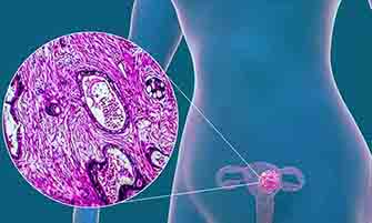 uterine cancer MOBILE