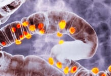 Most People Develop Diverticulosis In Their Gut by Age 80