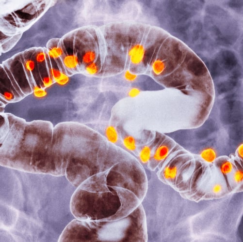 diverticulosis CROP