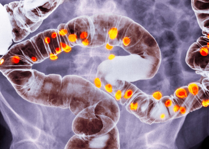 diverticulosis ORIGINAL