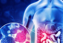 What Are the Different Types of Surgery For Bowel Cancer?