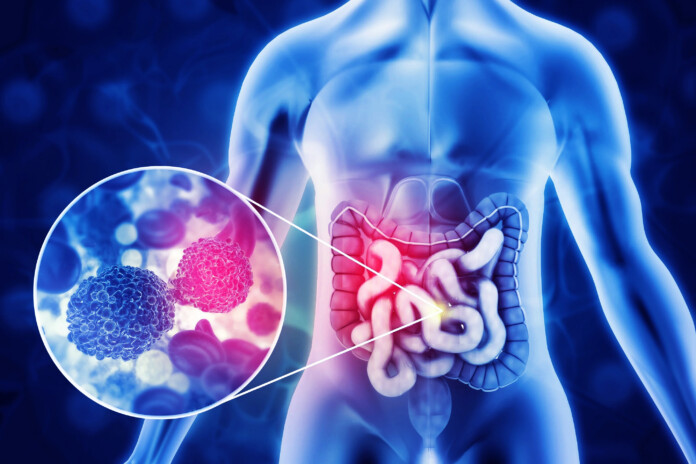 Colon cancer ORIGINAL