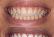 Thinking About Teeth Whitening? What To Know Before You Start