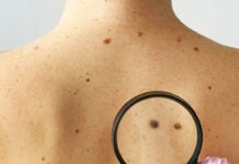 What Are the Signs and Symptoms of Skin Cancer?
