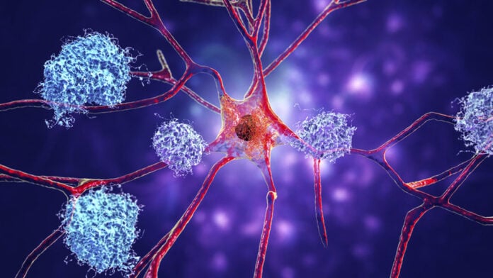tau tangles in Alzheimers